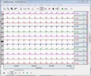 Mobita 12-lead ECG
